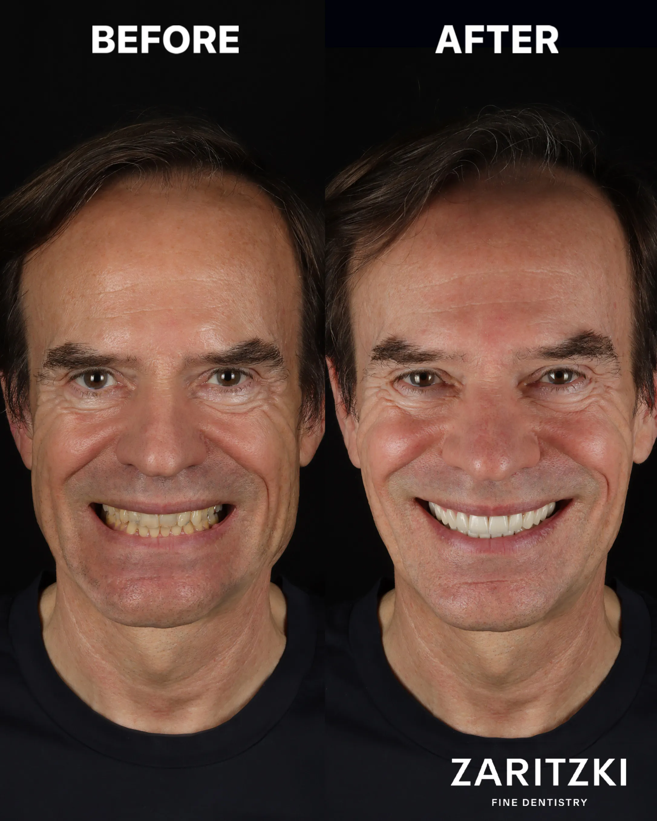 Bissrekonstruktion nach Bruxismus, vorher und nachher, Zaritzki Fine Dentistry, Berlin
