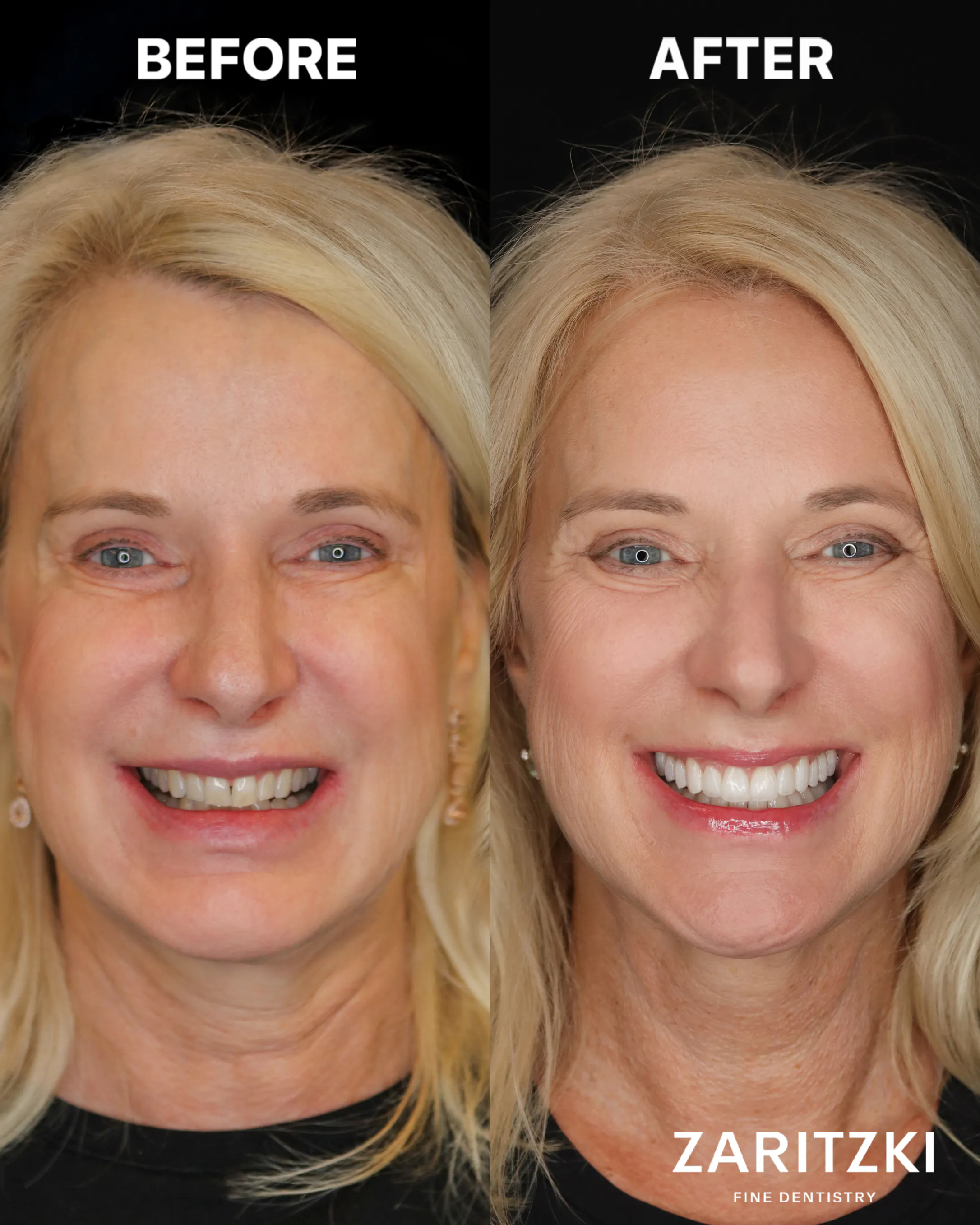 Bissrekonstruktion nach früherer Kieferorthopädie, vorher und nachher, Zaritzki Fine Dentistry, Berlin