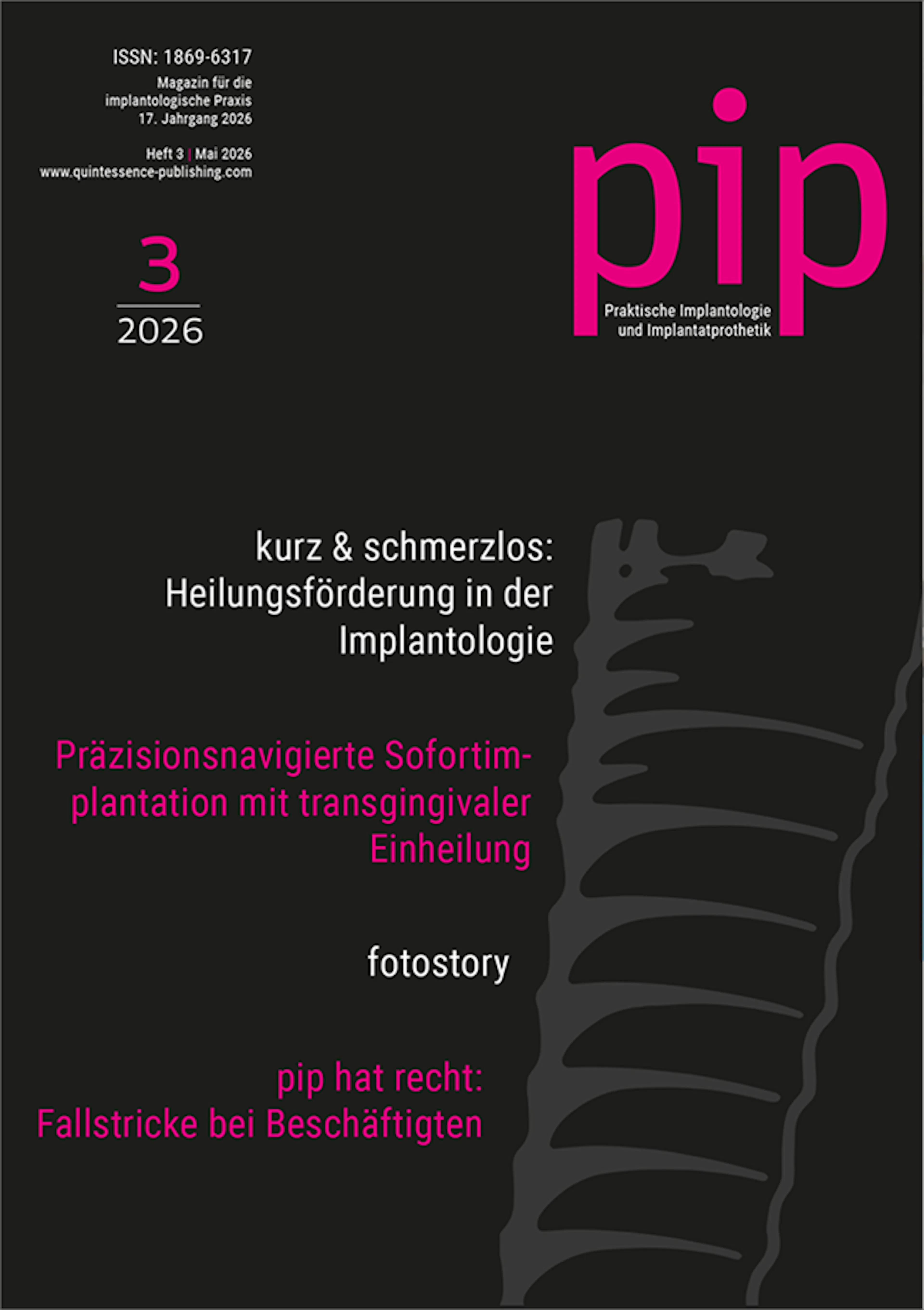 Pip Cover Fachbeitrag Präzisionsnavigierte Sofortimplantation mit transgingivaler Einheilung Dr. Felix Zaritzki, Dr. Fabian Meinke