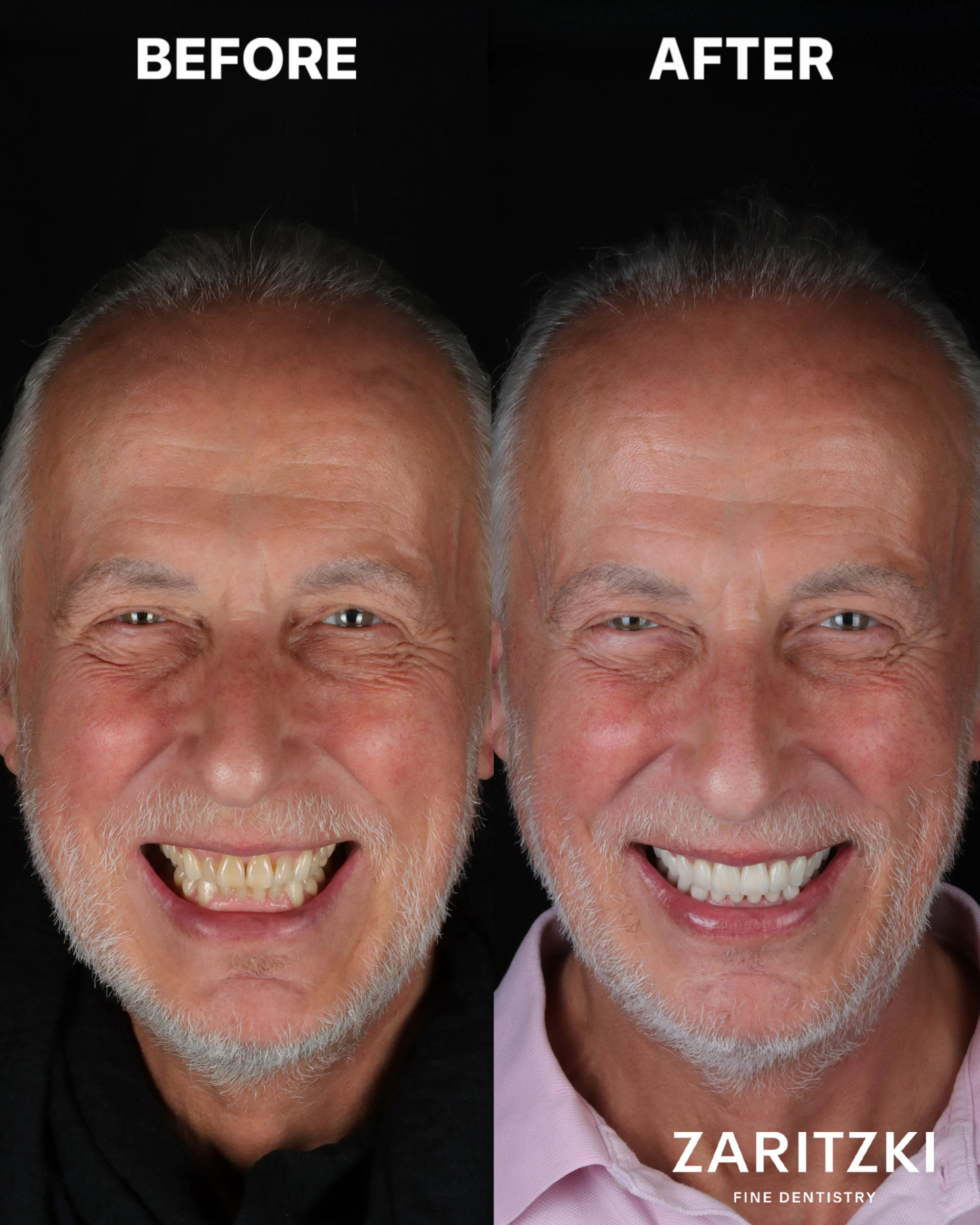 Abgenutzte Zähne und verlorene Bisshöhe, vorher und nachher, Zaritzki Fine Dentistry, Berlin
